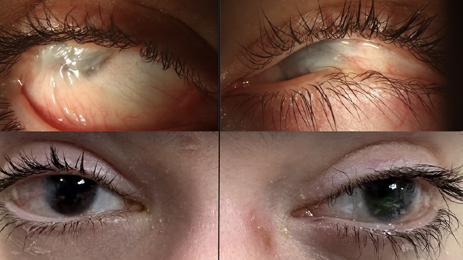 A new gene therapy proves effective in treating a rare disease, as shown in this before-and-after image.